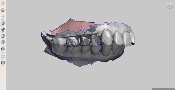 Patient Dentition Scanned Into Computer